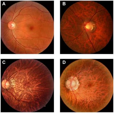 Optimized-Unet: Novel Algorithm for Parapapillary Atrophy Segmentation